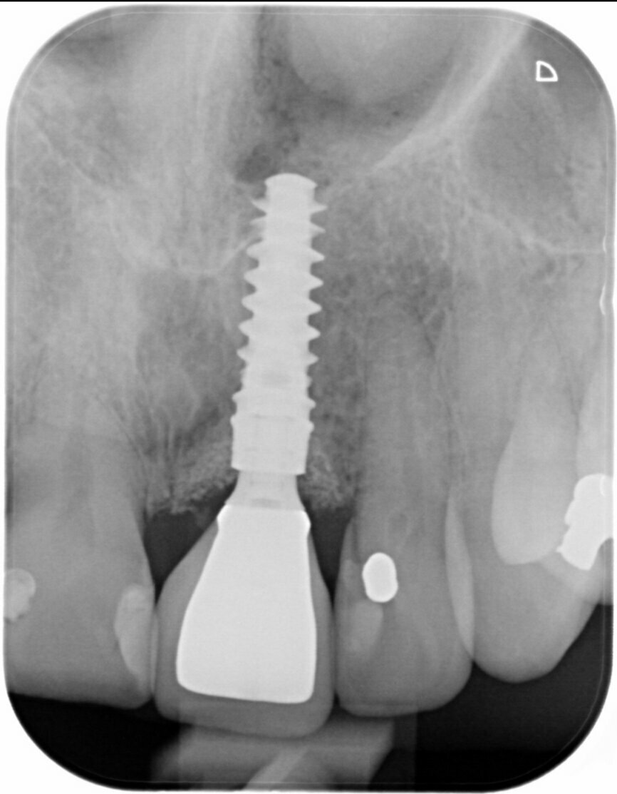 Fig. 33: Final result radiograph.