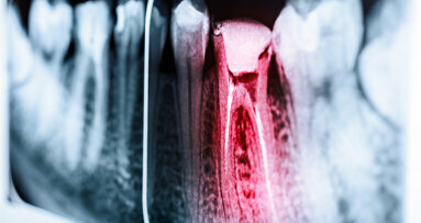 Tutkijat kehittävät älypuhelinsensoria hammaskivun havaitsemiseksi