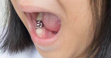 Crown and go: Kiwi study investigates pioneering method to treat caries
