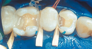 Aesthetic restoration of posterior teeth with composite resins and ceramic inlays