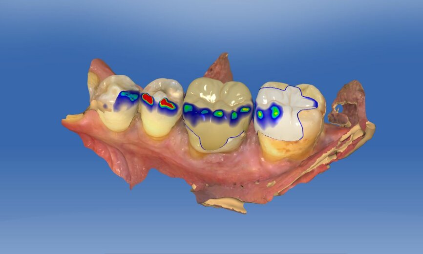Fig. 5b: CAD construction in the mandible.