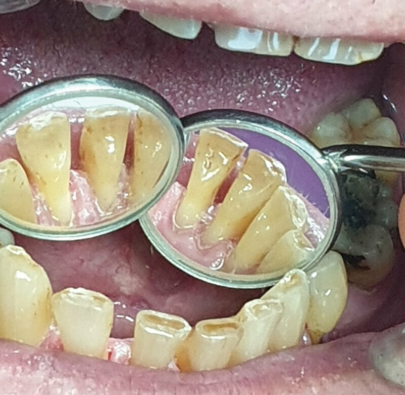 Sl. 2.4: Pacijent B, nakon potpunog prestanka pušenja, poliranja i uklanjanje zubnog kamenca i mekih naslaga