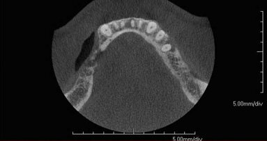 Edentulous patients can benefit from the integration of CBCT data