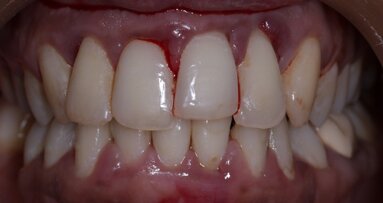 Recent study in Japan finds a possible link between bruxism and periodontal disease