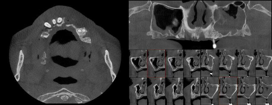 Figs. 3a–c: Initial CT scan with cross-sectional (a), coronal (b) and sagittal (c) views.