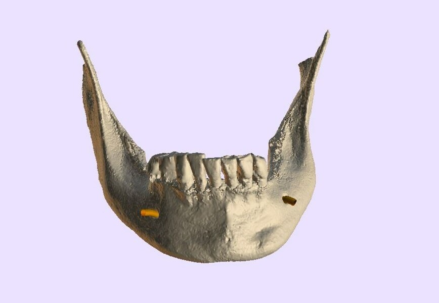 Fig. 6b: The isolated mandibular arch.