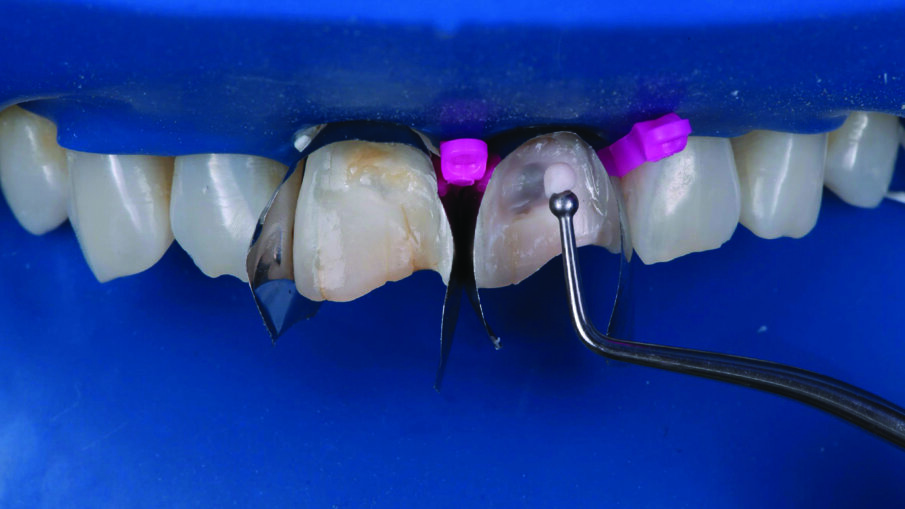 A 1 mm layer of the Pink Opaquer (PO) was placed onto the discolored sclerotic dentin to mask dark areas and light cured for 20 seconds. The material offered a similar creamy handling as the body shades of 3M™ Filtek™ Universal Restorative.