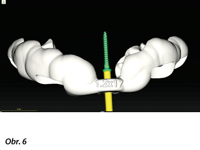Virtuální kopie pozice vrtáčku (1,2 × 17 mm) ve 3D šabloně.