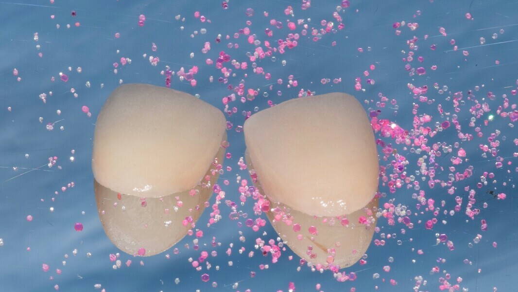Fig. 2: Ceramic partial fixed dental prostheses (veneers) before the try-in.