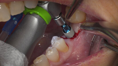 Conventional and immediate loading with final n!ce screw-retained crowns