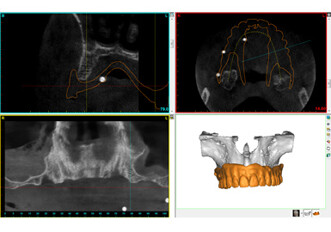 Materialise Dental launches the Dual Scan Package