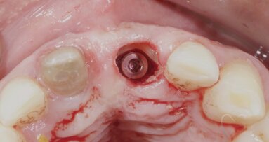 Consultant prosthodontist shares insight into the Socket-Shield Technique