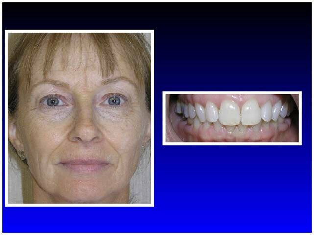Fig. 1 Pretreatment facial and anterior intra-oral photographs (note deep dental overbite).