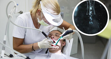 空化射流能够更轻易地移除牙菌斑