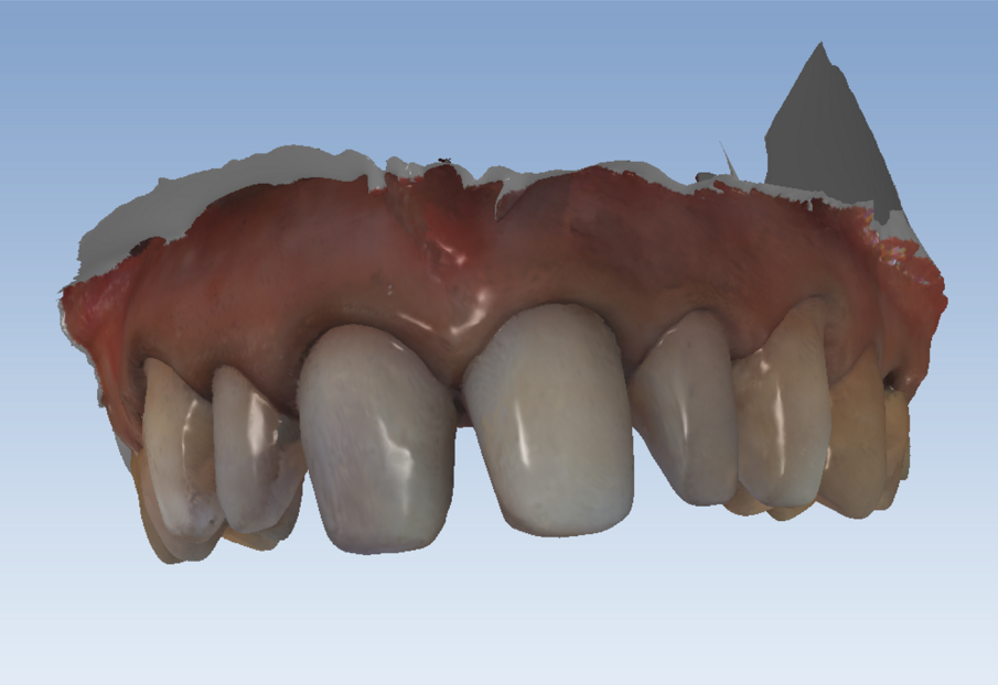 Fig. 4 - Scansione intra-orale.