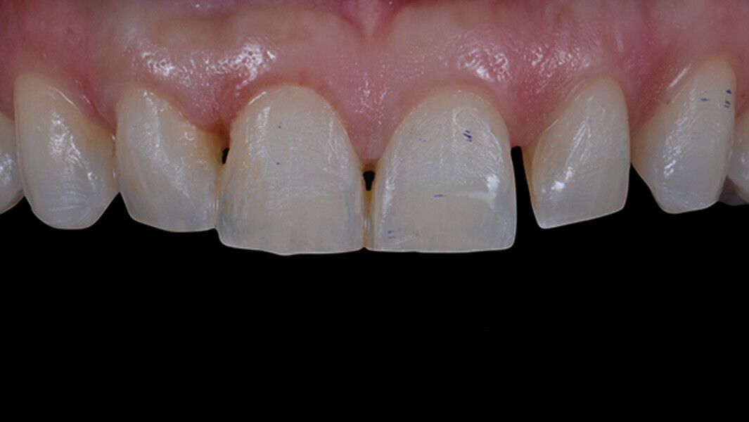Fig. 7. Tejido periodontal de los dientes anteriores seis meses después del alargamiento coronario.