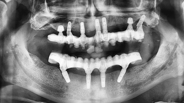 Kombinace standardních a ultrakrátkých implantátů při rehabilitaci celých úst