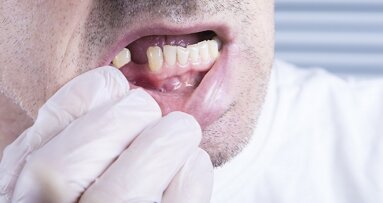 Middle-aged tooth loss linked to increased coronary heart disease risk