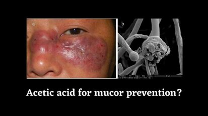 Acetic acid to prevent mucormycosis - Dr. Puneet Wadhwani (OMFS)