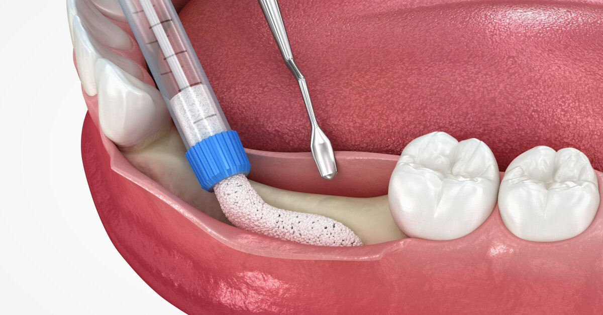 Webinar to concentrate on peri-implant tissue augmentation