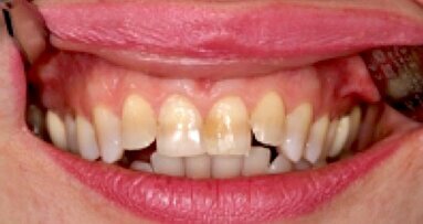 Rehabilitación de dientes anteriores con carillas CAD/CAM