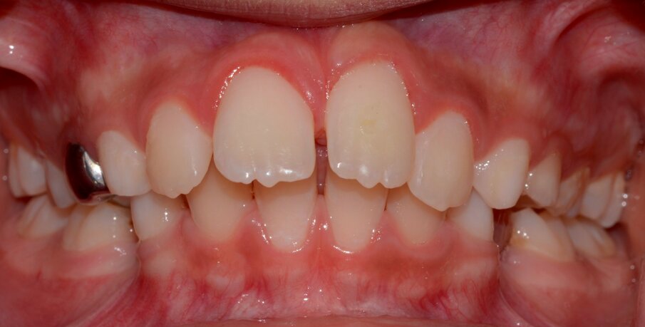 Figure 14: One year follow up. The patient and parent were pleased with the aesthetic result. 21 was vital and positively responsive to EC & EPT. The tooth was non mobile and produced a metallic sound indicative of ankylosis.