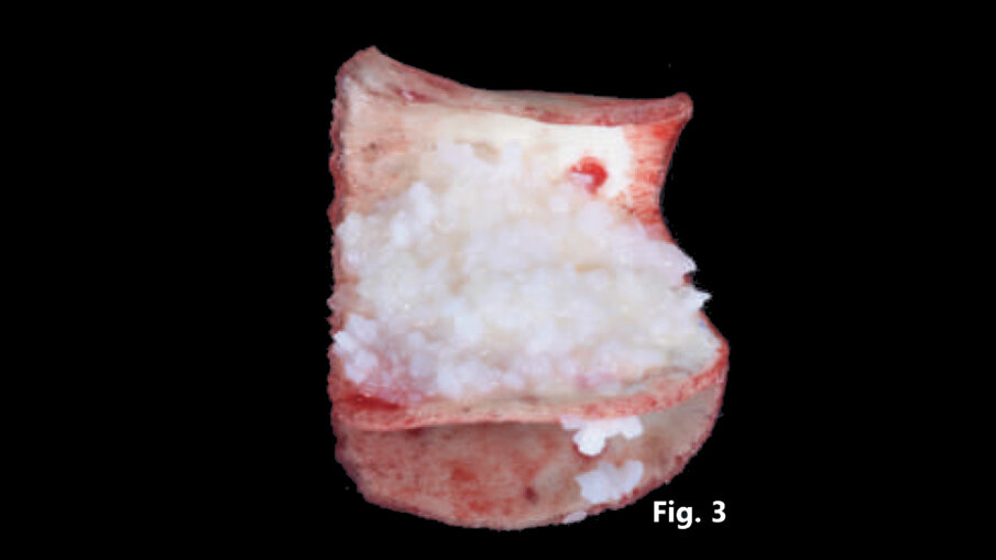 Fig. 3 - Preparazione dell’innesto: la lamina in osso corticale appena inumidita, fornisce il supporto ai granuli eterologhi di origine equina precedentemente miscelati in rapporto 1:1 con gel a base di DBM.