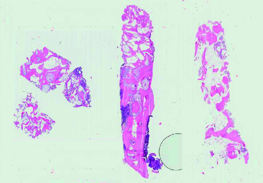 Figg. 7a-7c_Immagini istologiche delle tre biopsie ossee prelevate durante il posizionamento implantare, rispettivamente in posizione 1.3 (a), 1.1 (b) e 2.2 (c). Il primo campione si è frammentato durante il prelievo; il secondo campione mostra la maggiore quantità di tessuto osseo. La porzione apicale corrisponde probabilmente all’osso basale del paziente. Il terzo campione, corrispondente a una posizione ove era presente l’emostatico invece della membrana, mostra una buona ossificazione, sebbene più rarefatta. 