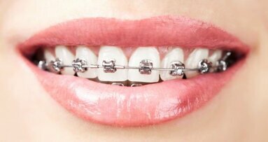 Orthodontisten onder vuur: tarieven gedaald, omzet stijgt