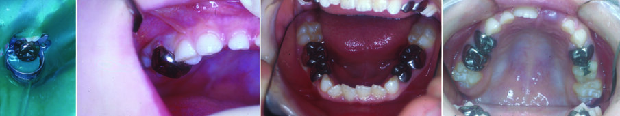 Figures 3 (a, b, c, d): The conventional specialist paediatric dentist approach: The SSC is sized up and trialed (Figure 3a), The rubber dam is removed and the SSC is cemented with a glass ionomer (Figure 3b). Figures (3 c & d) show upper and lower arches restored conventionally with SSCs using LA, rubber dam & high speed drills. Compare these with the teeth in Figure 10