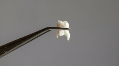 机器学习算法可能有助于预测牙齿缺失