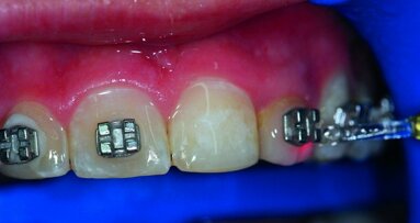 Le laser Er:YAG dans les phases de collage et de dépose des brackets lors du traitement orthodontique