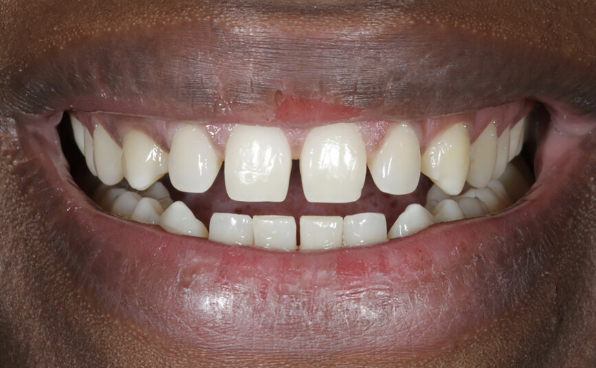 Fig. 84: Smile before and after the treatment.