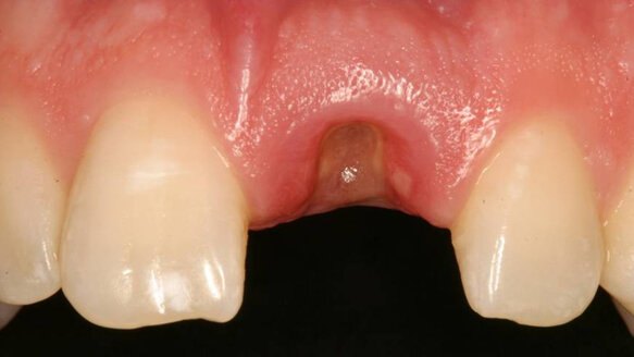 Management of a single implant in the esthetic zone