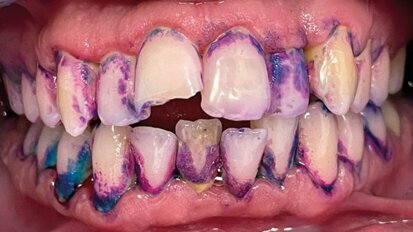 Efficacia di un dentifricio bioadesivo sui tessuti parodontali: uno studio prospettico su soggetti “special needs”