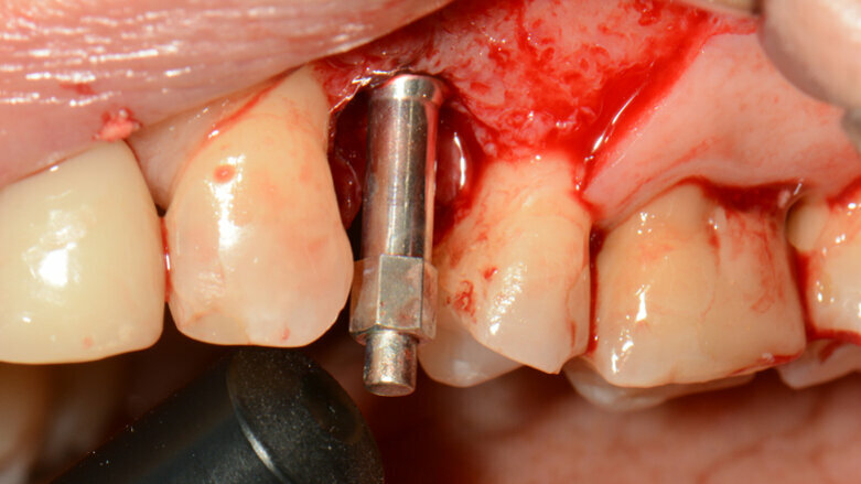 “We are not selling implants”—rethinking immediate dental implant loading