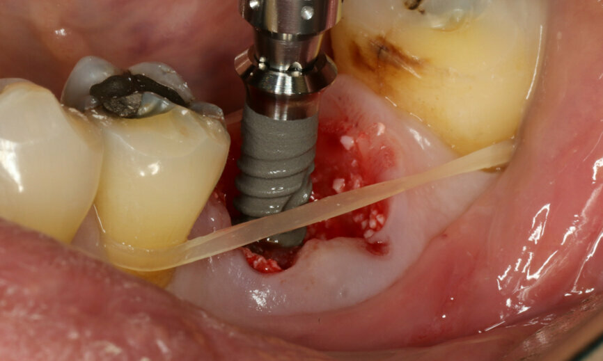 Fig. 13: Straumann TLX implant insertion.