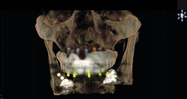 The 3-D Difference: Cone Beam CT diagnostics to enhance treatment—Part II