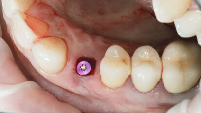 Nanotechnology may improve soft-tissue integration of dental implants