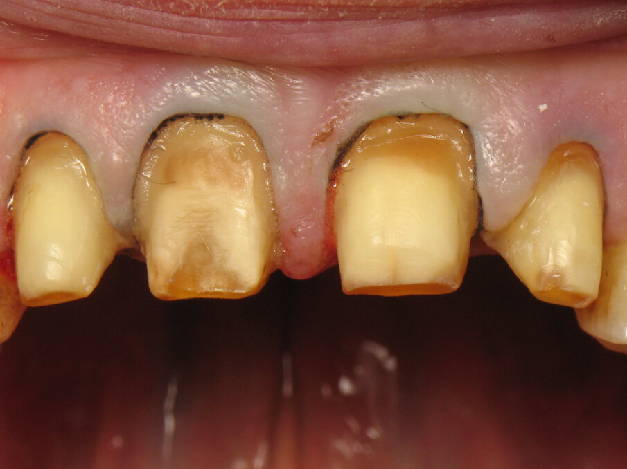 Fig. 9: Close-up of the tooth preparation and retraction cord placement.