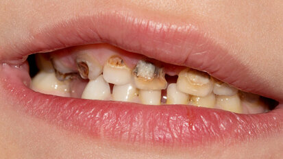 Tooth extractions are main reason for children's hospital admissions