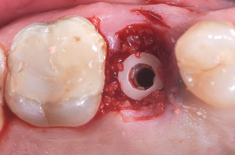 Fig. 19 : Pose de l’implant deux pièces en céramique au niveau tissulaire.