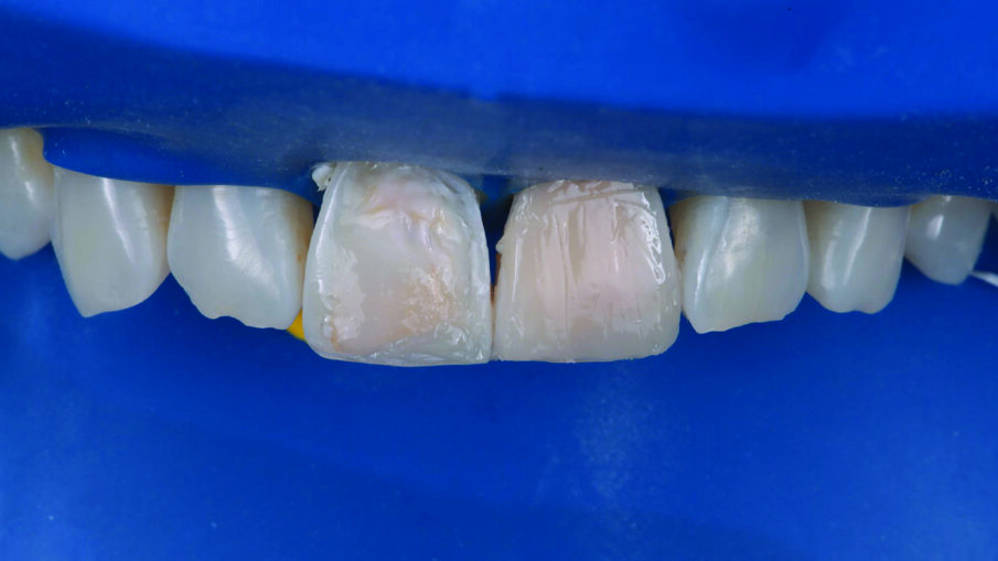 Appearance of the teeth after the first application of 3M™ Filtek™ Universal Restorative A1 shade. No additional body shades were needed (to mask sclerotic dentin) when using the Pink Opaquer.