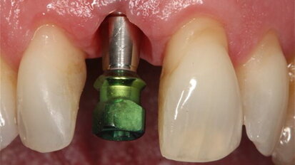 A simple, esthetic & inexpensive technique for a custom implant abutment