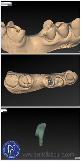 Slika 8:  slučaj merilend mosta, izgled intra oralnog skena u  Exocad DentalCAD programu; stomatološka ordinacija Varga, dr Zoran Varga