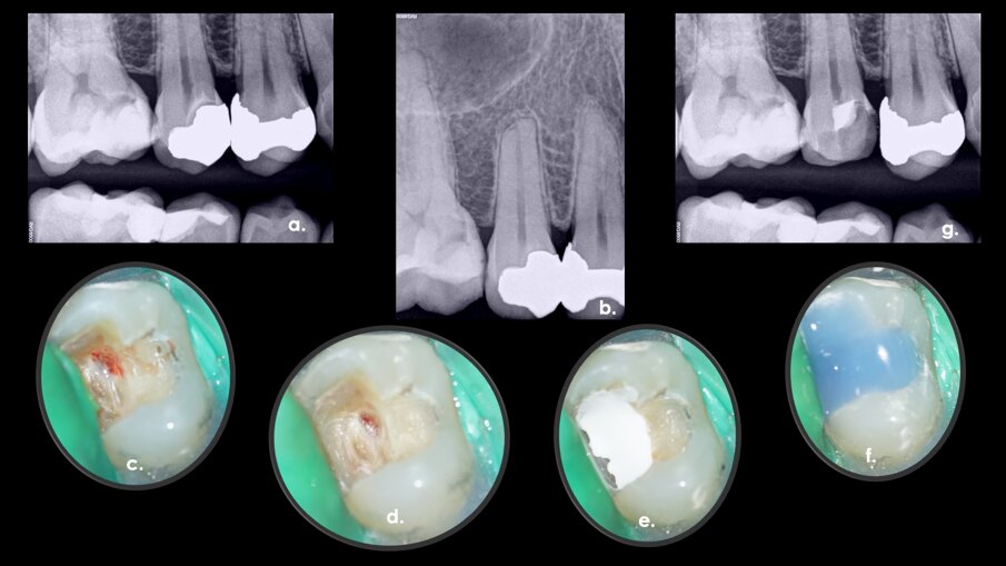 Fig. 1a–g: A direct pulp capping procedure sequence. Initial bitewing radiograph. The proximity of the previous restoration to the pulp space was evident (a). Initial periapical radiograph. No evidence of periapical disease (b). Pulp exposure (c). Pulp exposure after haemostasis, achieved after applying pressure with a sterile cotton pellet for 20 seconds (d). Placement of pulp capping material before removal of excess material in the peripheral areas (e). Non-radiopaque temporary restoration in place (f). Post-op radiograph taken at the end of the first appointment with the non-radiopaque temporary restoration in place (g).
