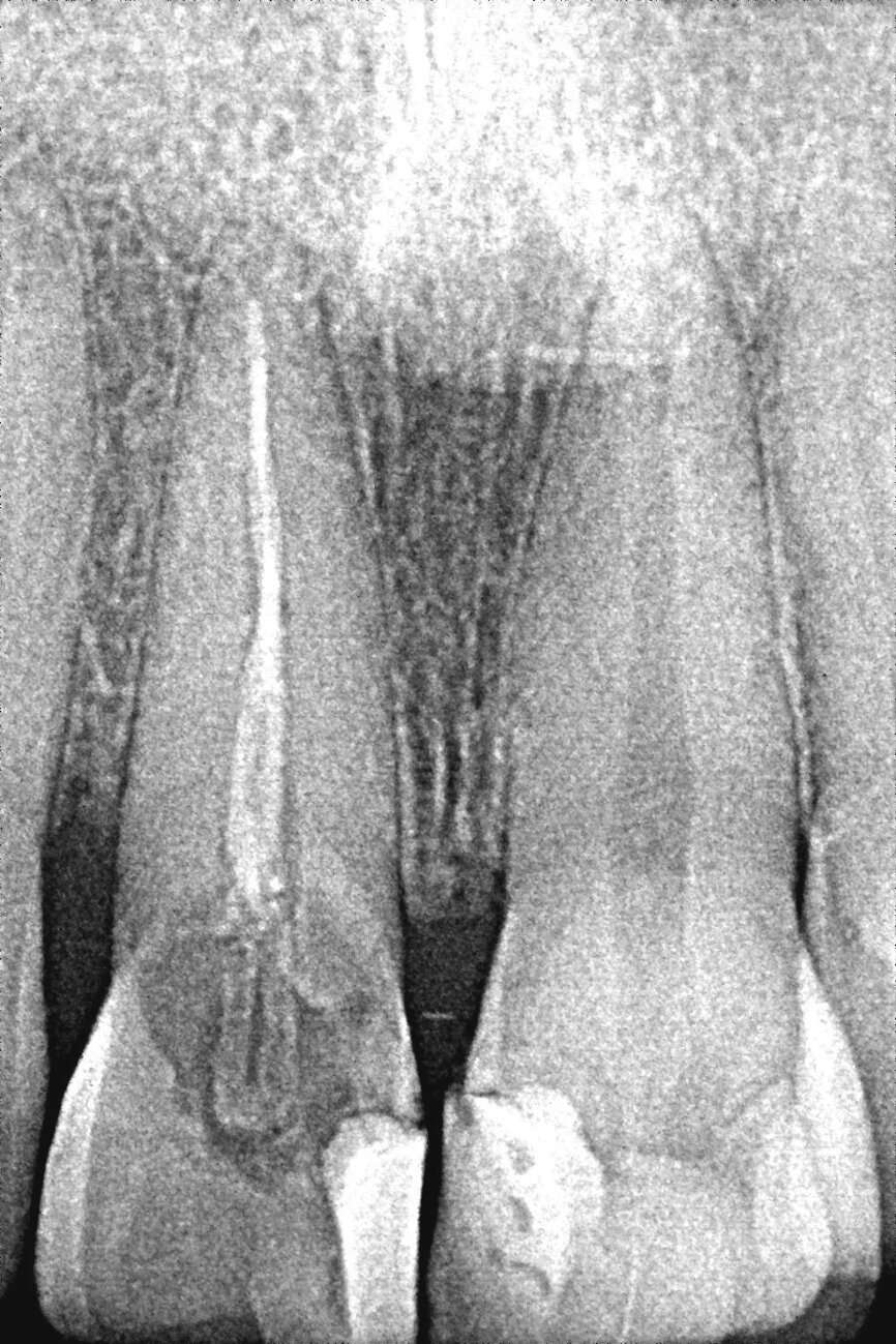 Fig. 1c : Radiographie de la dent 21. 