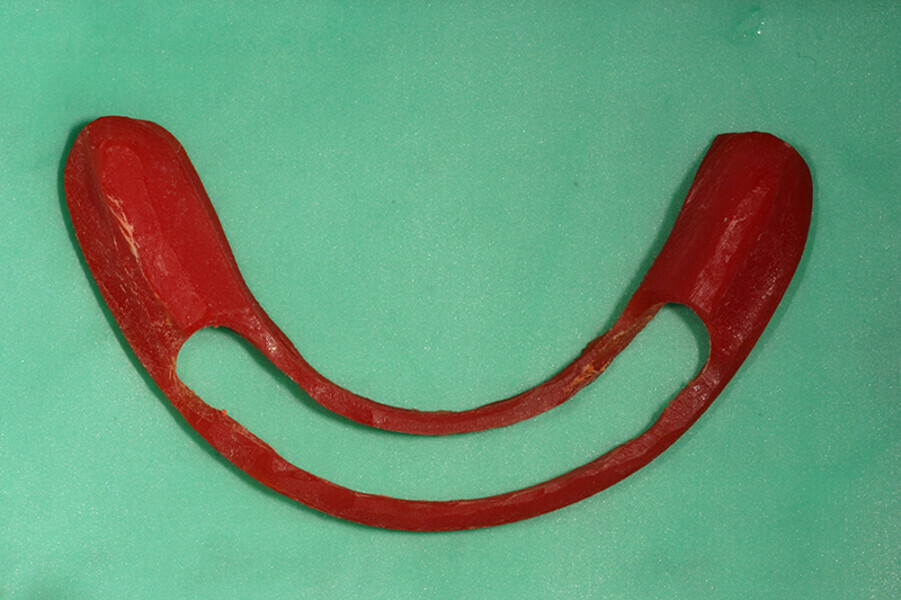 Fig. 1. Barra de Duralay® OSU, modelo rígido donde se fabrica la barra y barra metálica colada.