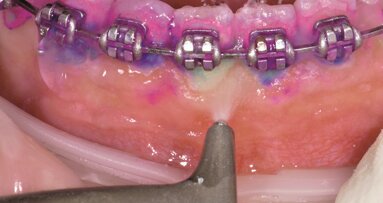 Ortodontický pacient – z pekla do nebe