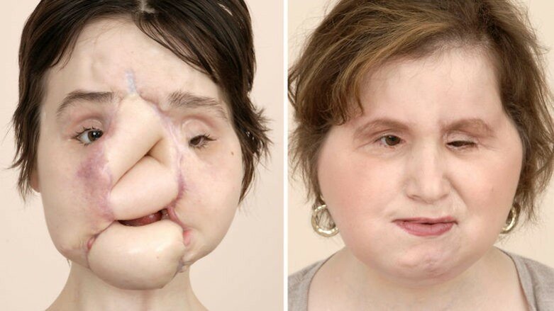 Succesvolle gezichtstransplantatie bij jonge vrouw